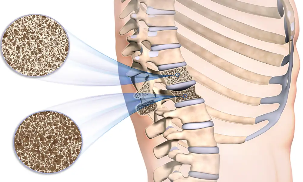 How To Interpret Bone Mineral Density Test Results