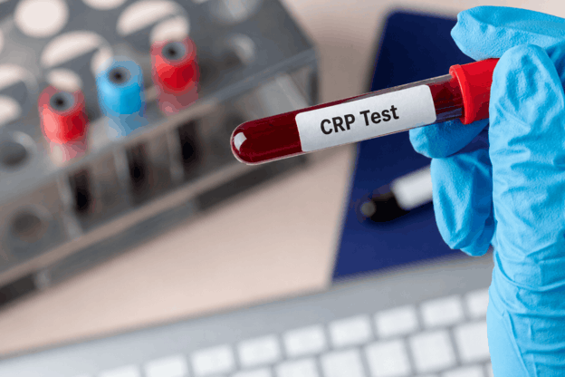What Is a CRP Test: Decoding Inflammation Markers in Your Blood Report